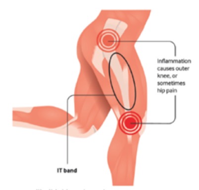 SINDROME BANDELLETTA ILEOTIBIALE